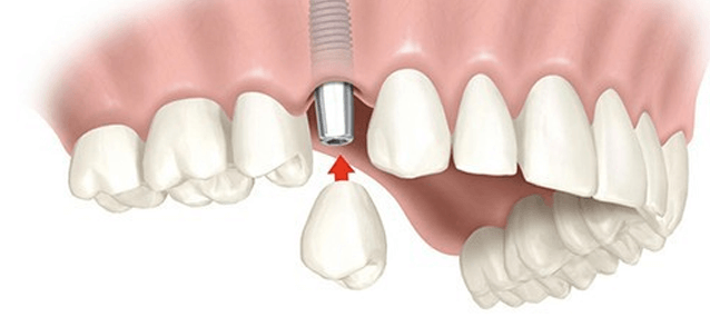 одномоментная имплантация зубов под ключ